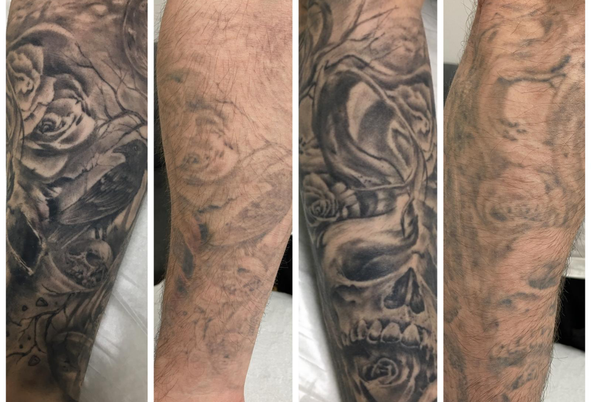 Pictures of before and after tattoo removal